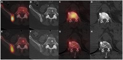 Nuclear medicine imaging for bone metastases assessment: what else besides bone scintigraphy in the era of personalized medicine?